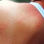 Аллергия на пот: причины, симптомы, что делать
