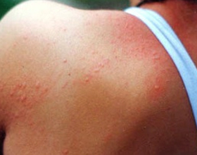 Аллергия на пот: причины, симптомы, что делать