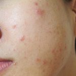 Аллергические прыщи на лице: симптомы, причины и что делать