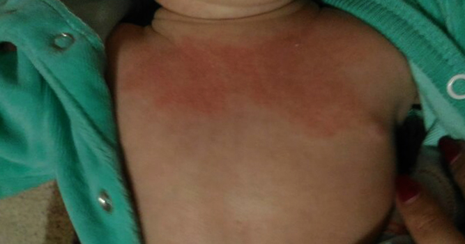 Аллергия на груди у малыша