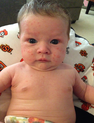 Проявление аллергии у малыша
