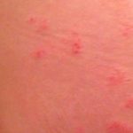 Аллергия на попе у грудничка: причины, симптомы и лечение