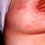 Аллергия на груди и под ней: причины, симптомы и что делать