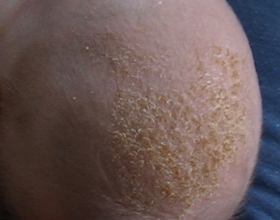Аллергия на голове у грудничка — причины, симптомы и лечение