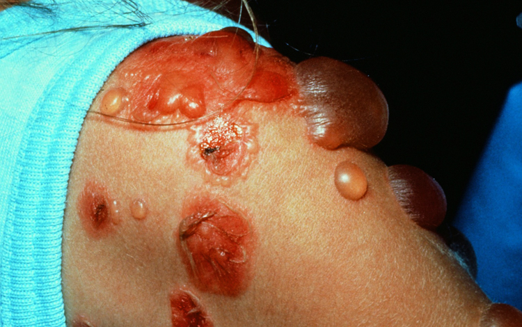 Как выглядит буллезный дерматит