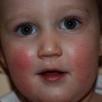 Аллергия на щеках у ребенка: симптомы и чем лечить (с фото)