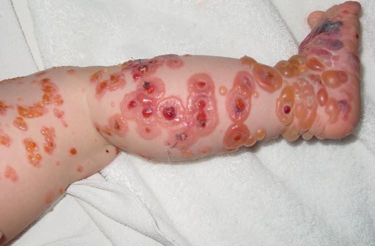 Проявление буллезного дерматита у ребенка