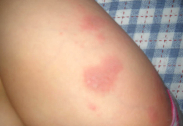 Аллергия на ногах в виде красных пятен