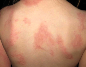 Виды и формы аллергии на коже у детей (с фото)