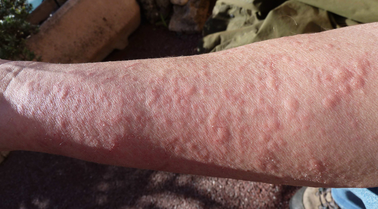 Аллергия на холод на ногах