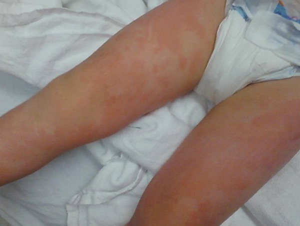 Аллергия на ногах у ребенка