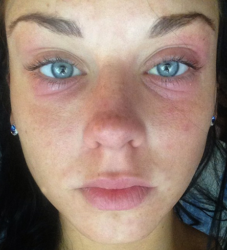 Аллергия на лице
