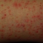 Пузырчатый дерматит: основные причины, симптомы и лечение