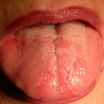 Аллергия на языке: причины, симптомы и что делать