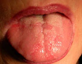 Аллергия на языке: причины, симптомы и что делать